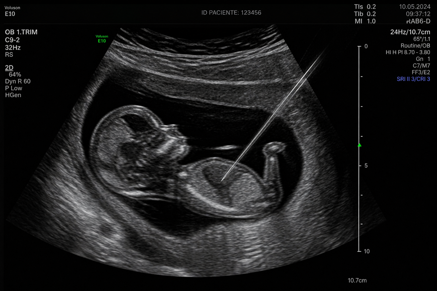 Assistolia fetal do