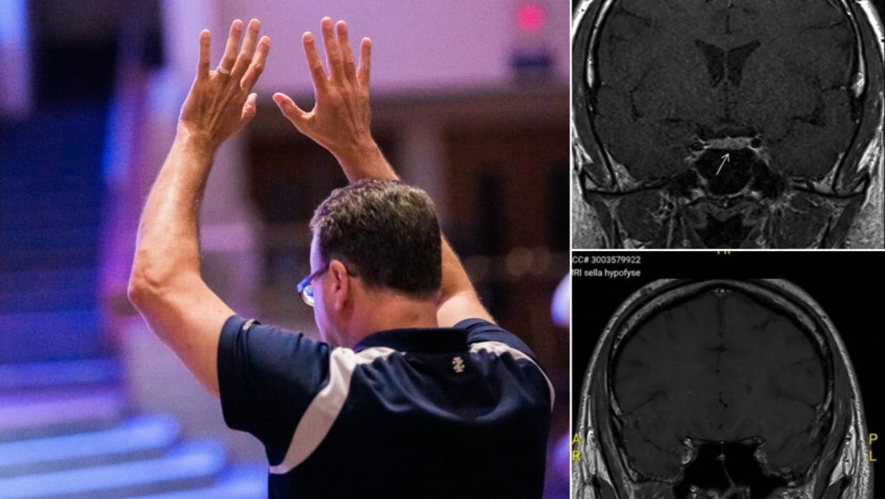 Tumor cerebral em